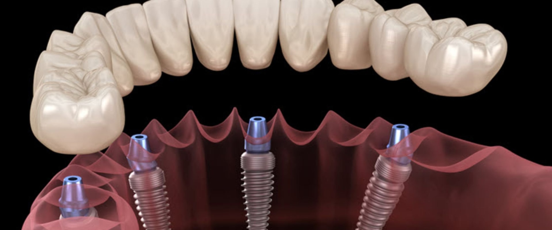 Dentistry In Allen, TX Why Proper Personal Protective Equipment Is